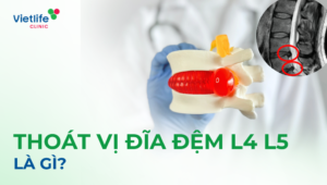 Thoát vị đĩa đệm L4L5