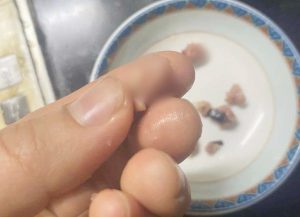 hạch lợn là gì