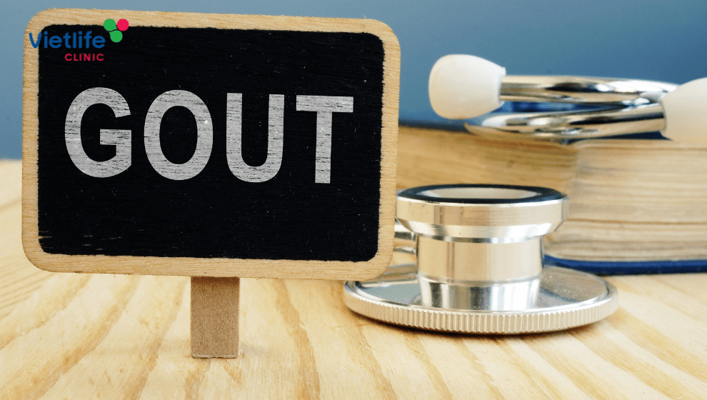 Điều trị bệnh gout