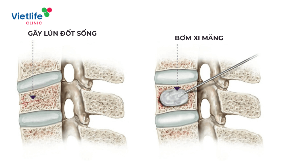 Bơm xi măng cột sống